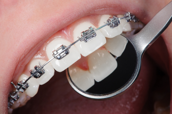Preguntas frecuentes sobre la ortodoncia
